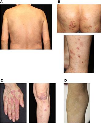 Cutaneous manifestations associated with immune checkpoint inhibitors